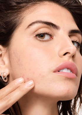 what-is-hormonal-acne-and-how-can-a-skincare-routine-help